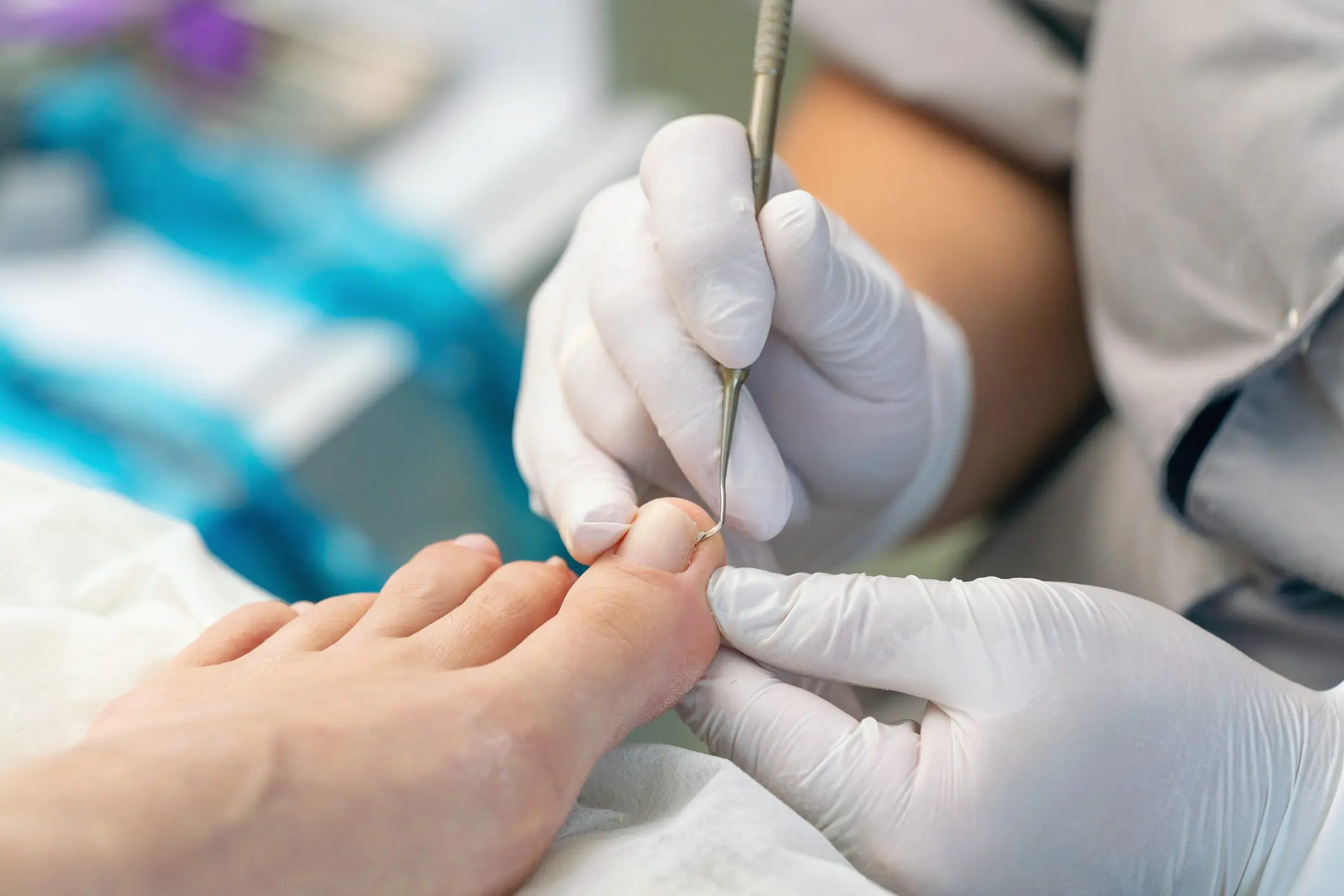 Podologist uses a curette to remove a callus on the toe.